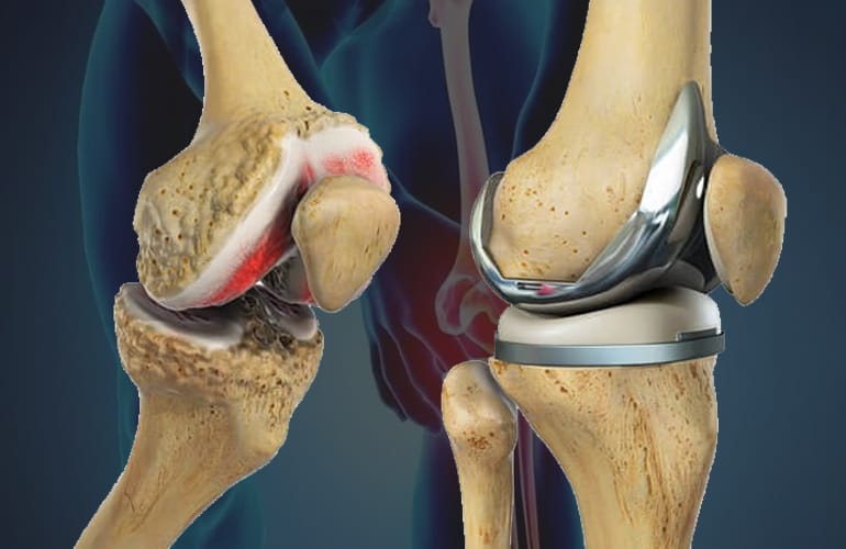 Joint Replacement in Manikonda